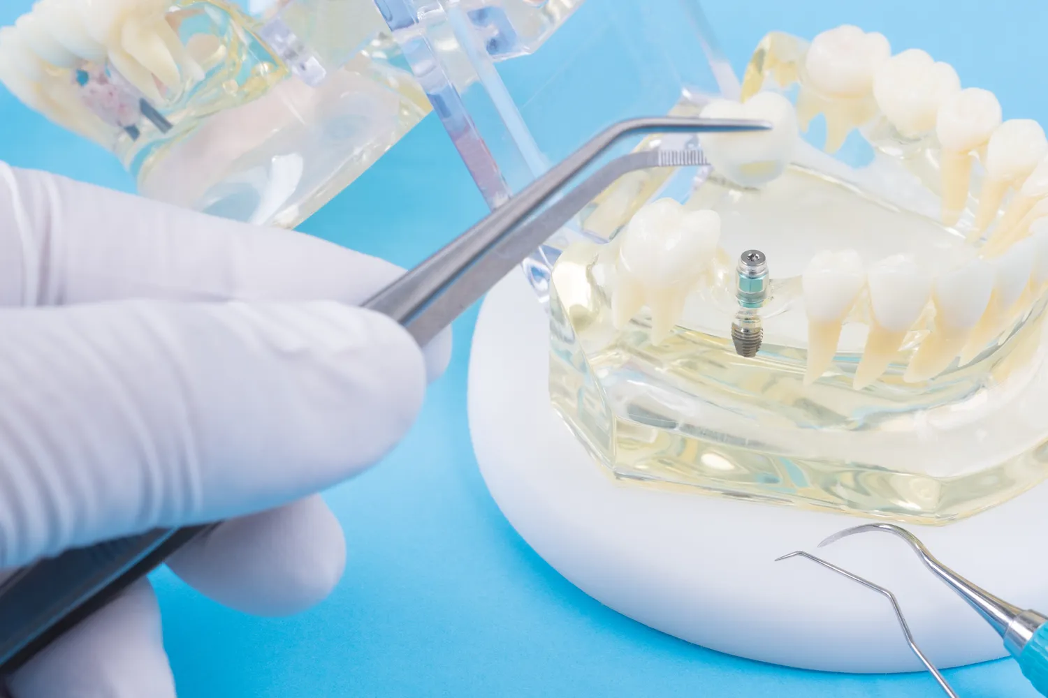 Implanty koszt Warszawa