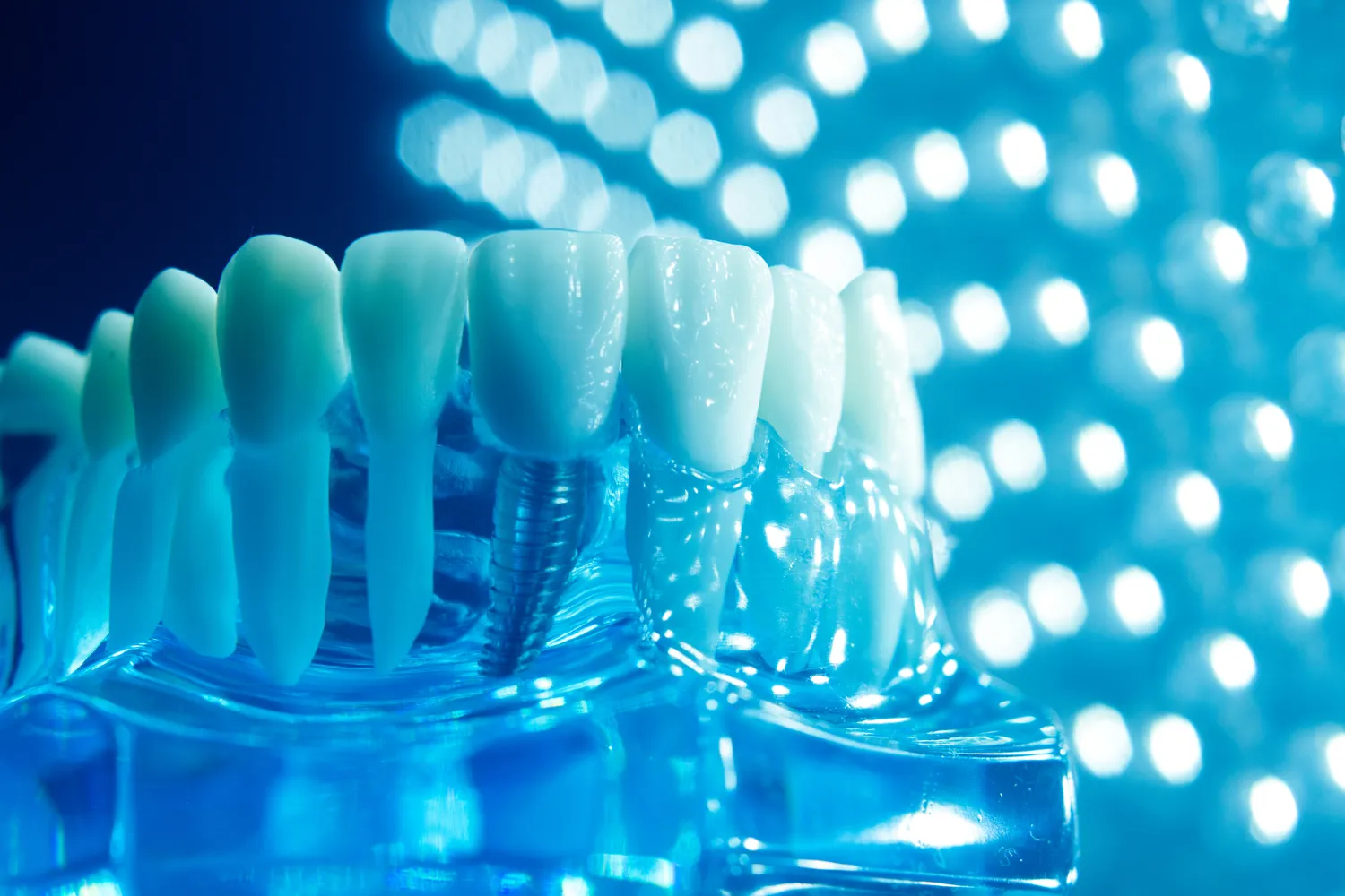 Implanty Szczecin gdzie najlepiej?