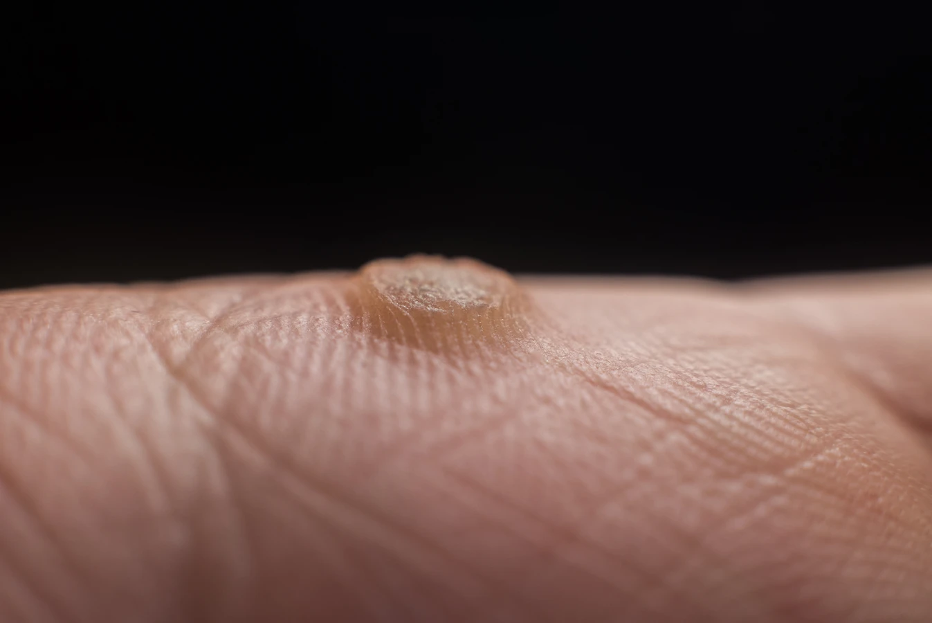 Od czego robią się kurzajki?