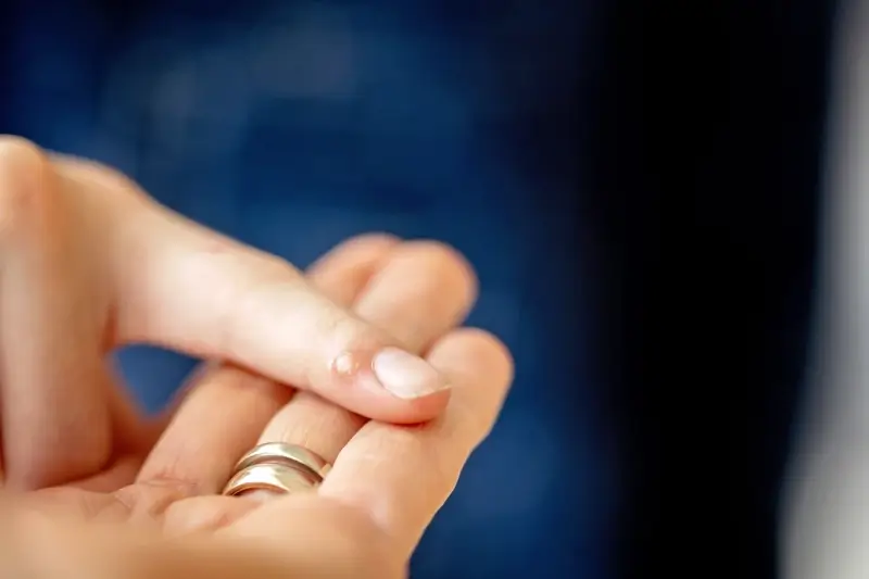 Od czego są kurzajki